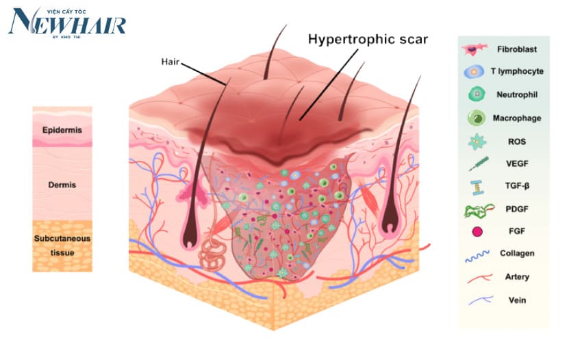 cấy tóc trên sẹo