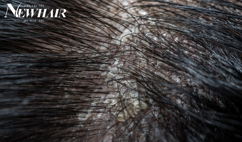 da đầu bít tắc