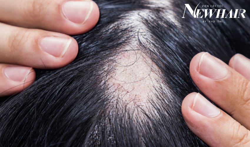 những nguyên nhân gây rụng tóc bất thường