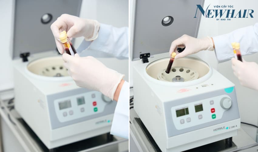quy trình tiêm prp tóc