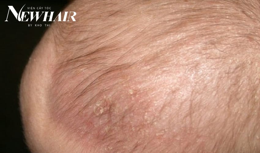 rụng tóc vành khăn ở trẻ sơ sinh