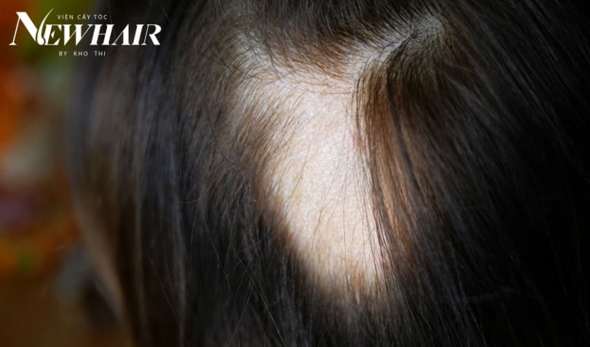 rụng tóc vành khăn ở trẻ