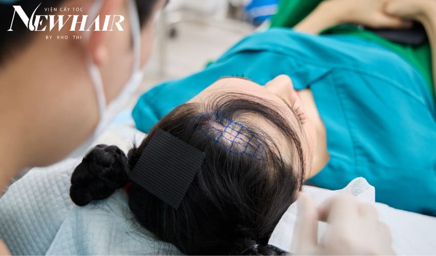 sẹo trên đầu có mọc tóc được không