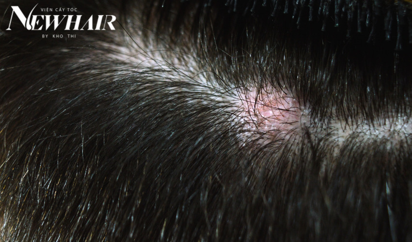 tìm hiểu các loại da đầu