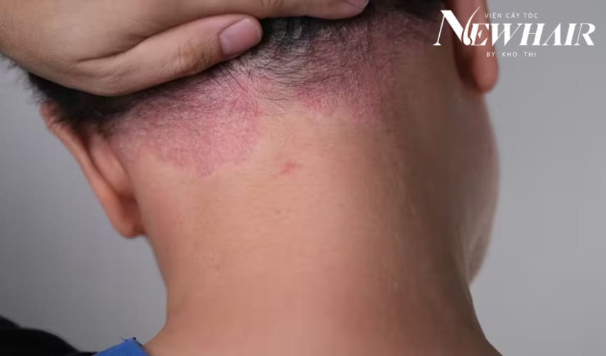 vảy nến da đầu