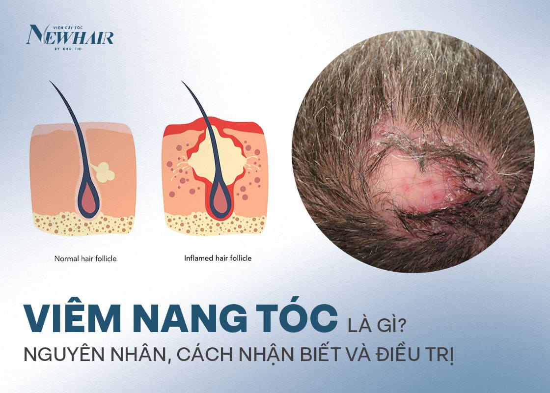 viêm nang tóc là gì
