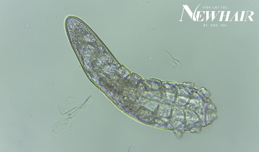 viêm nang tóc là gì