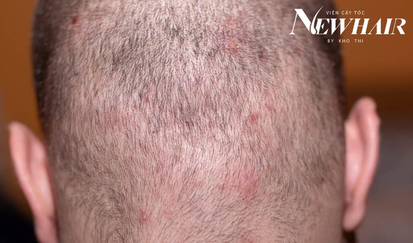 viêm nang tóc