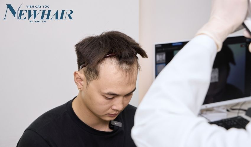 bị hói đầu khi còn trẻ