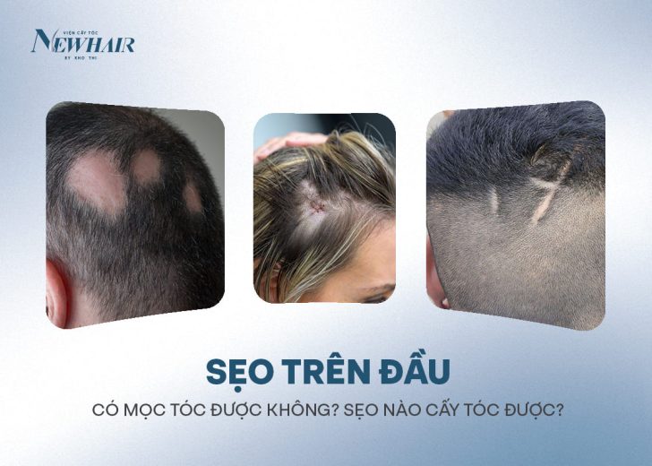 bị sẹo trên đầu có mọc tóc được không