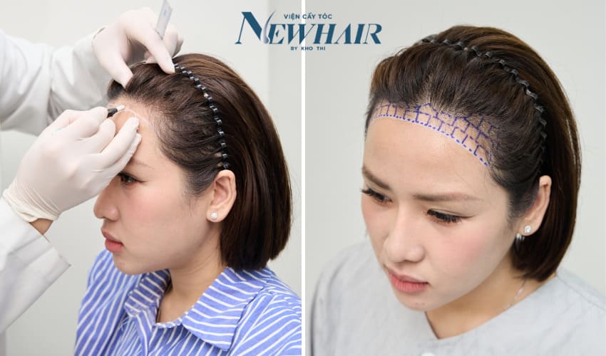 các bước cấy tóc phân tầng