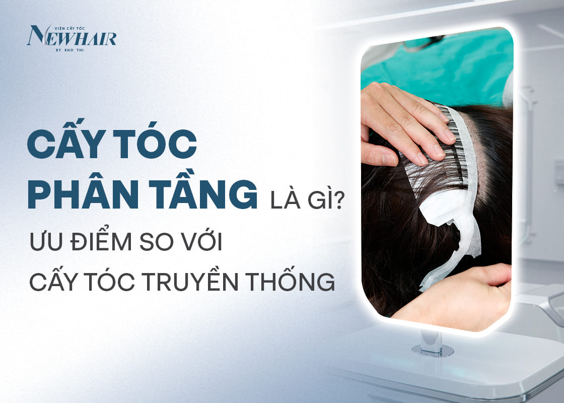 cấy tóc phân tầng