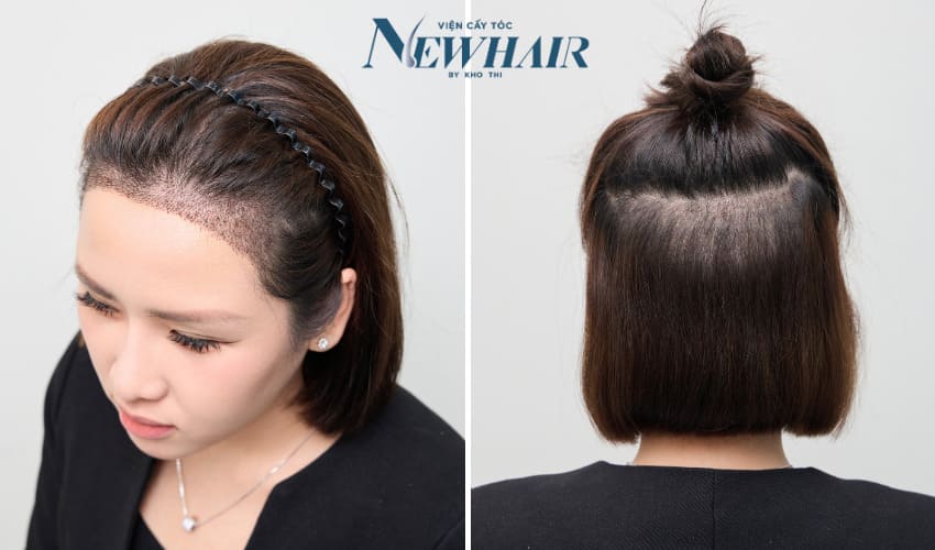 cấy tóc phân tầng là gì