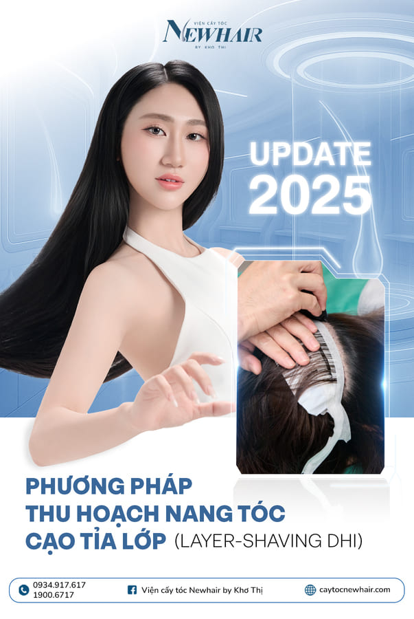 cấy tóc phân tầng là gì
