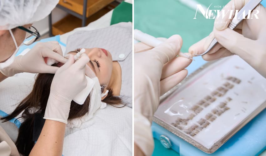 cấy tóc phân tầng tốt không