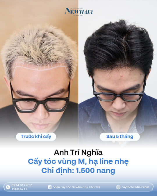 hạ đường chân tóc 1500 nang