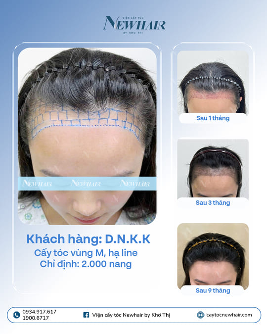 hạ đường chân tóc 2000 nang