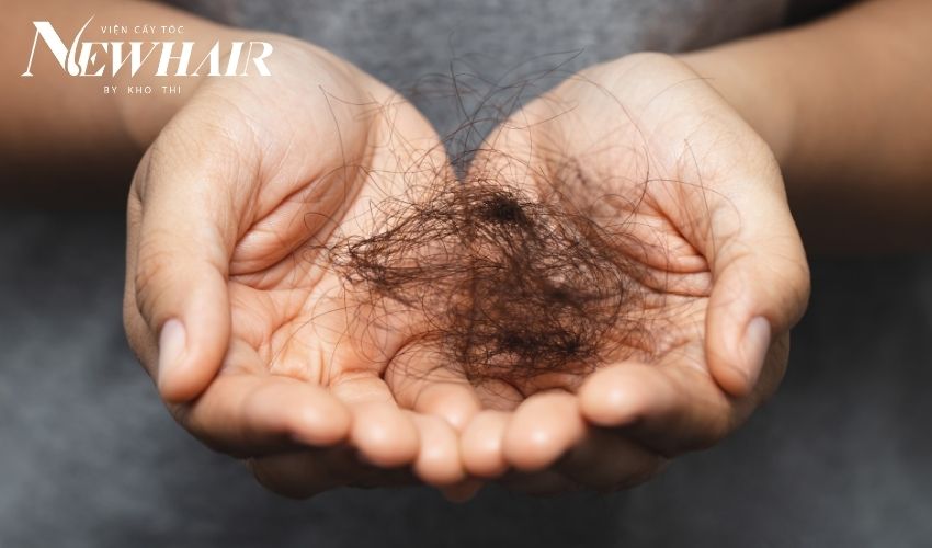 hói đầu khi còn trẻ