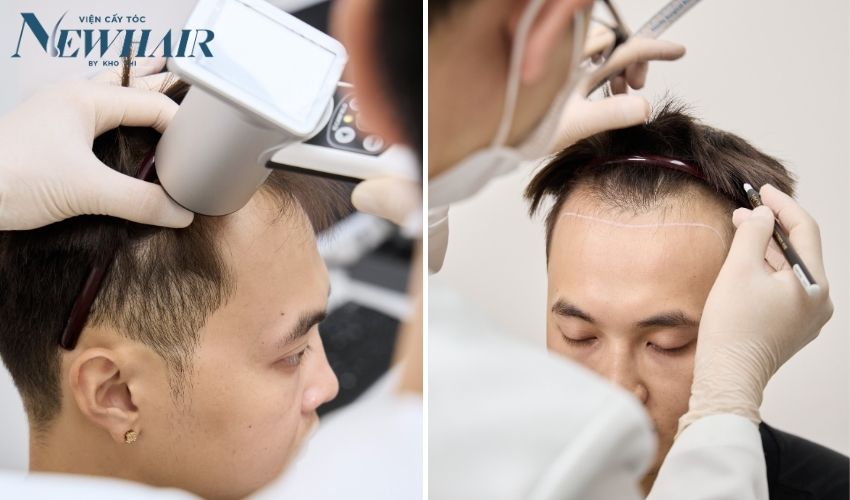 khám hạ đường chân tóc