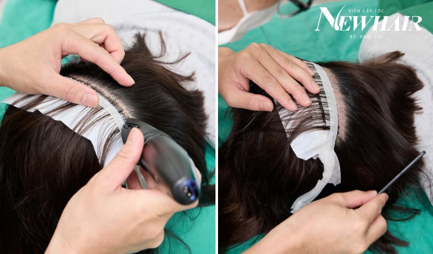 kỹ thuật cấy tóc phân tầng