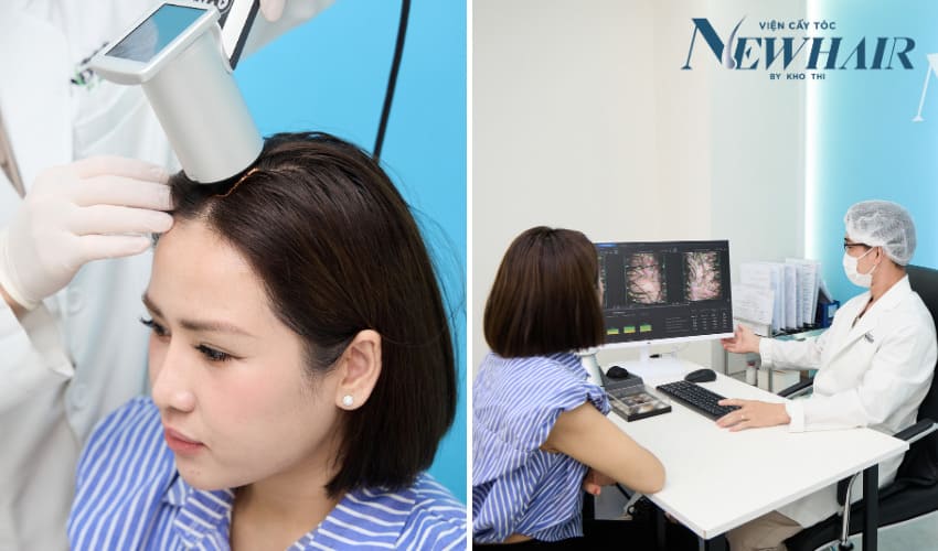 quy trình cấy tóc phân tầng newhair