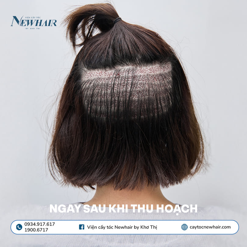tóc sau thu hoạch nang cấy tóc phân tầng