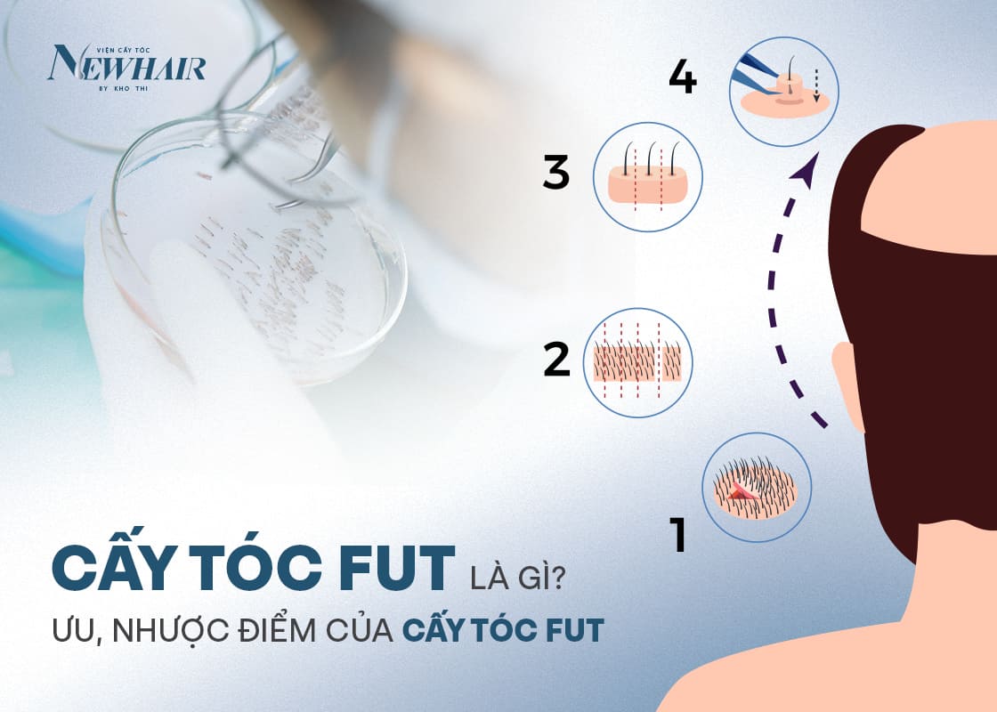 cấy tóc FUT là gì