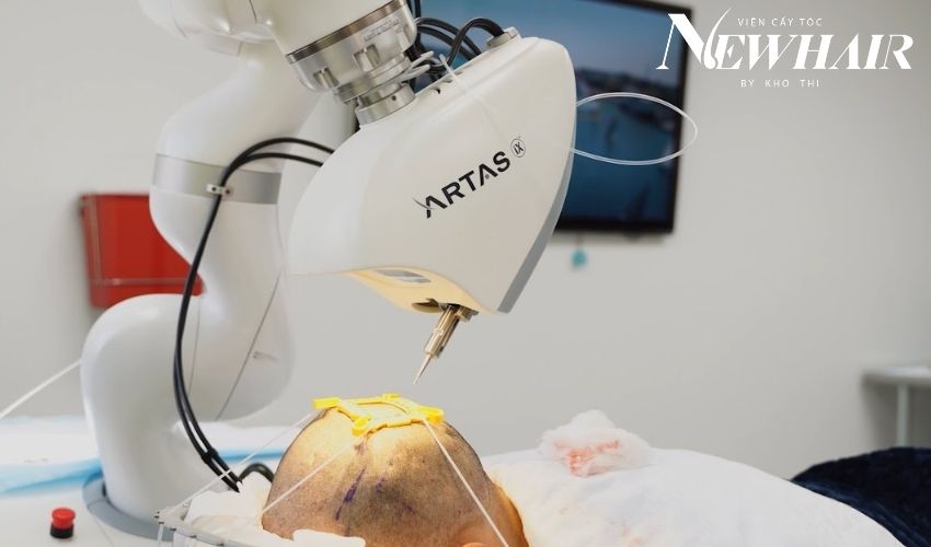 cấy tóc bằng robot