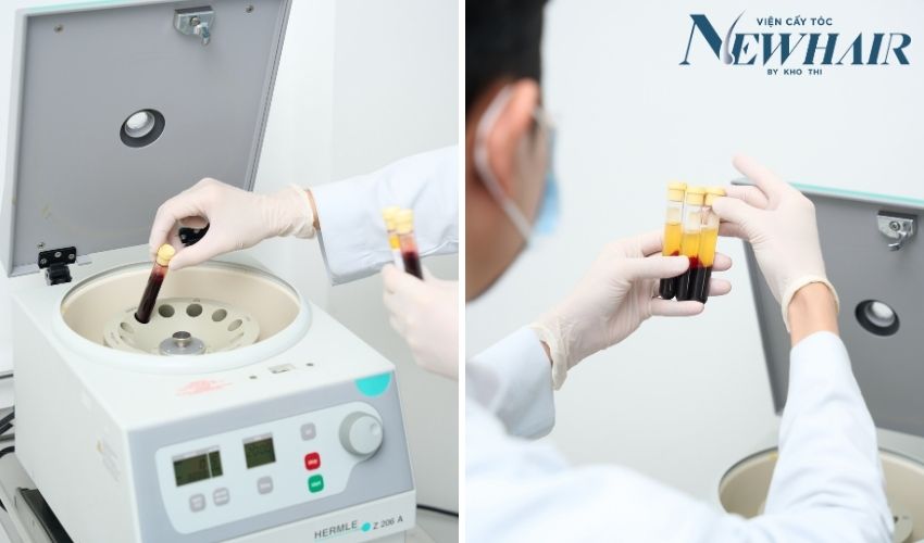 tiêm PRP trị rụng tóc hói đầu