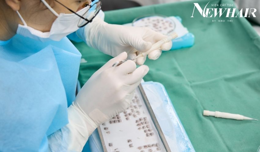 Chi phí cấy tóc ở TPHCM bao nhiêu