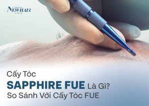 cấy tóc sapphire FUE