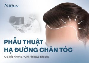 phẫu thuật hạ đường chân tóc