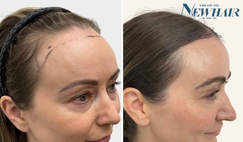 phẫu thuật hạ đường chân tóc là gì