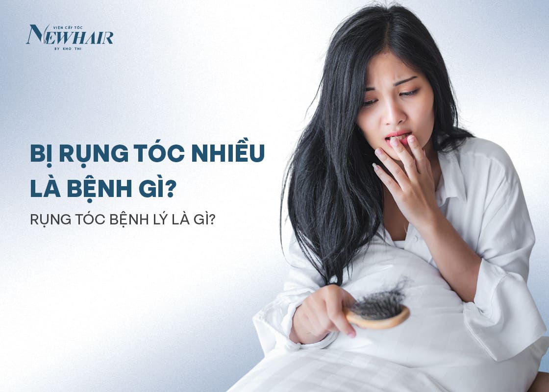 rụng tóc nhiều là bệnh gì