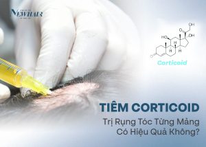 tiêm corticoid trị rụng tóc