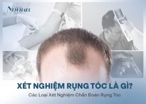 xét nghiệm rụng tóc