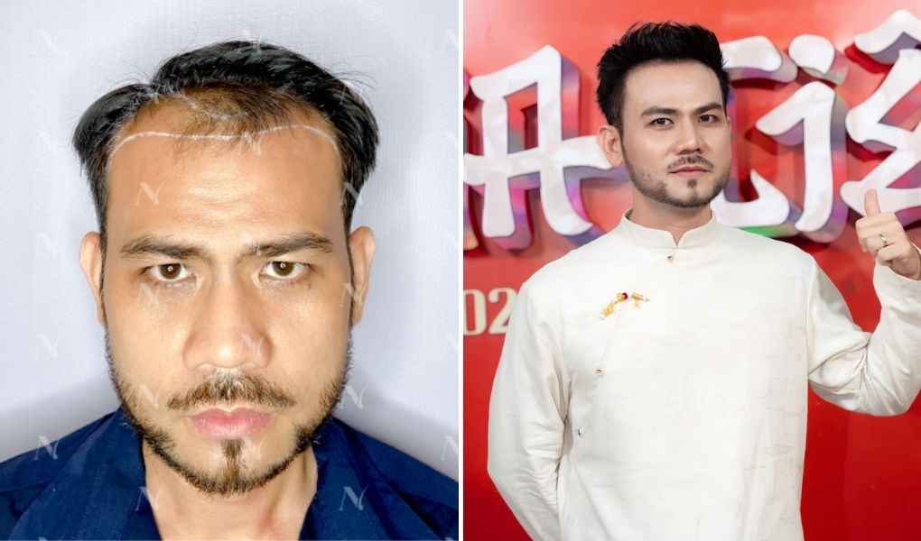 anh aquay cấy tóc