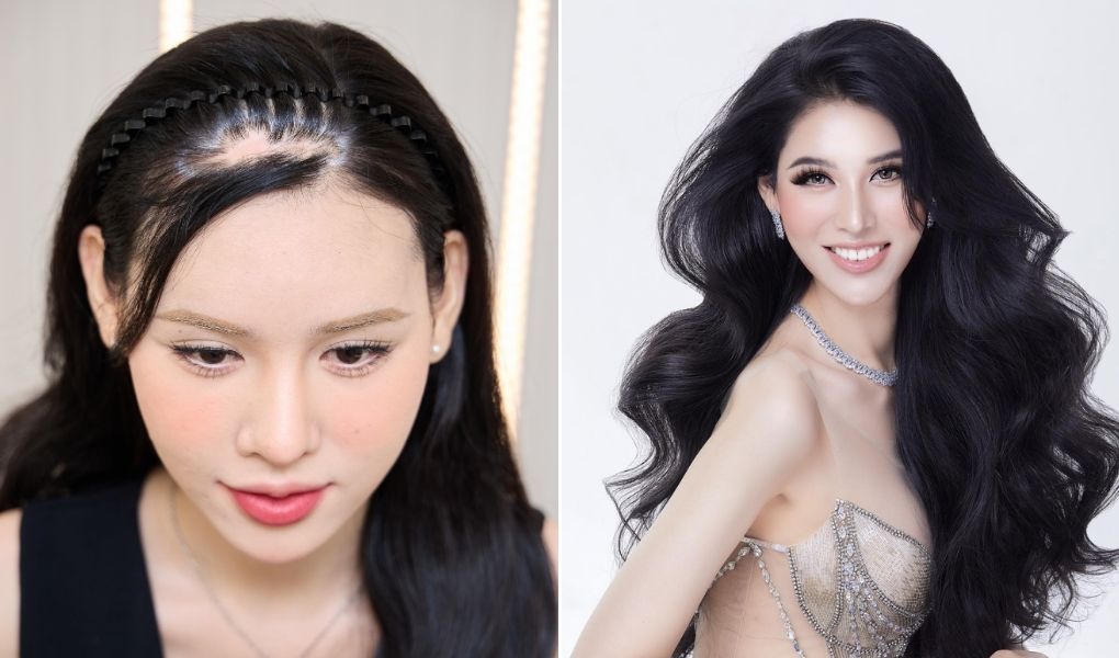 cấy tóc che sẹo dịu thảo