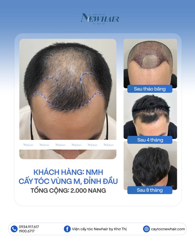 cấy tóc đỉnh đầu 2000 nang
