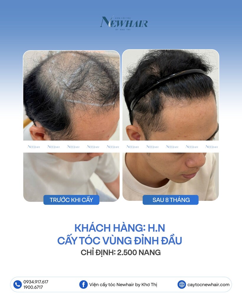 cấy tóc đỉnh đầu 2500 nang