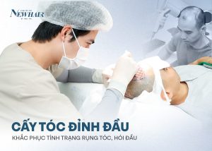 cấy tóc đỉnh đầu newhair trị hói