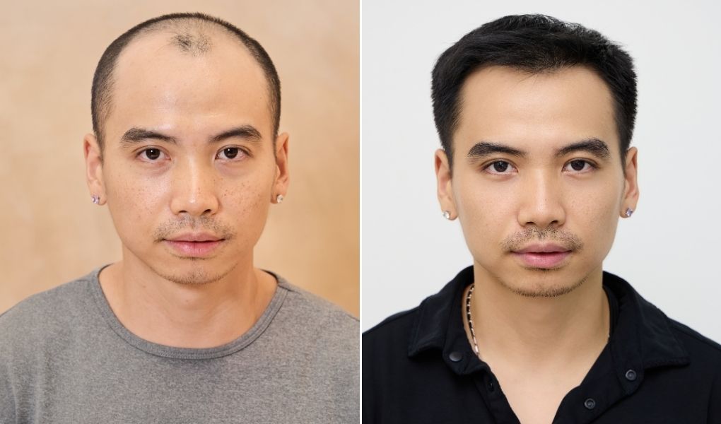 cấy tóc nam tuấn khôi