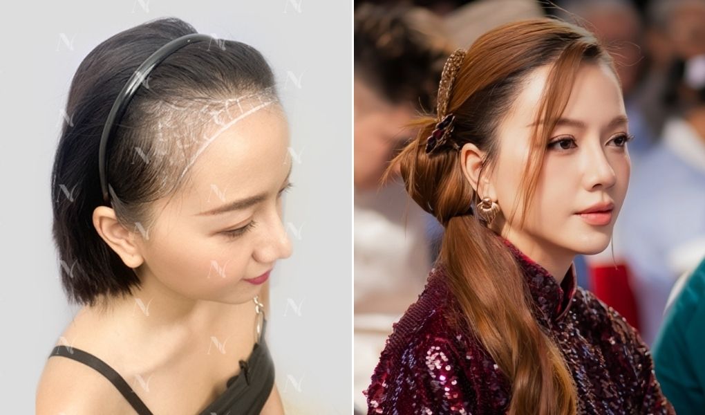 cấy tóc trị bò liếm băng di