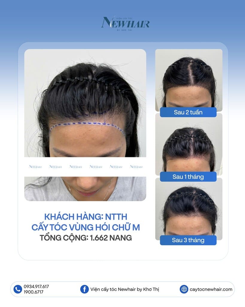 cấy tóc trị mái bò liếm cho nữ