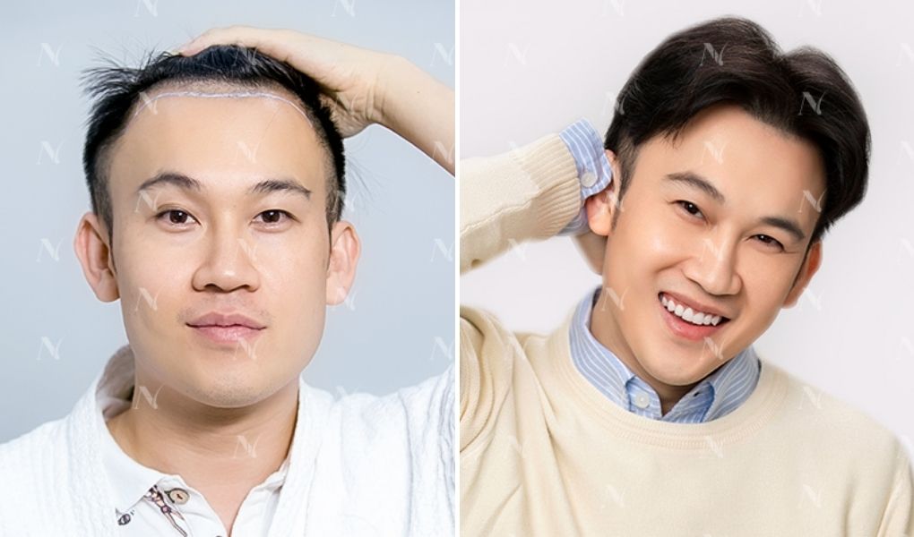 dương triệu vũ cấy tóc
