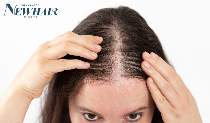 hói đường chân tóc là gì