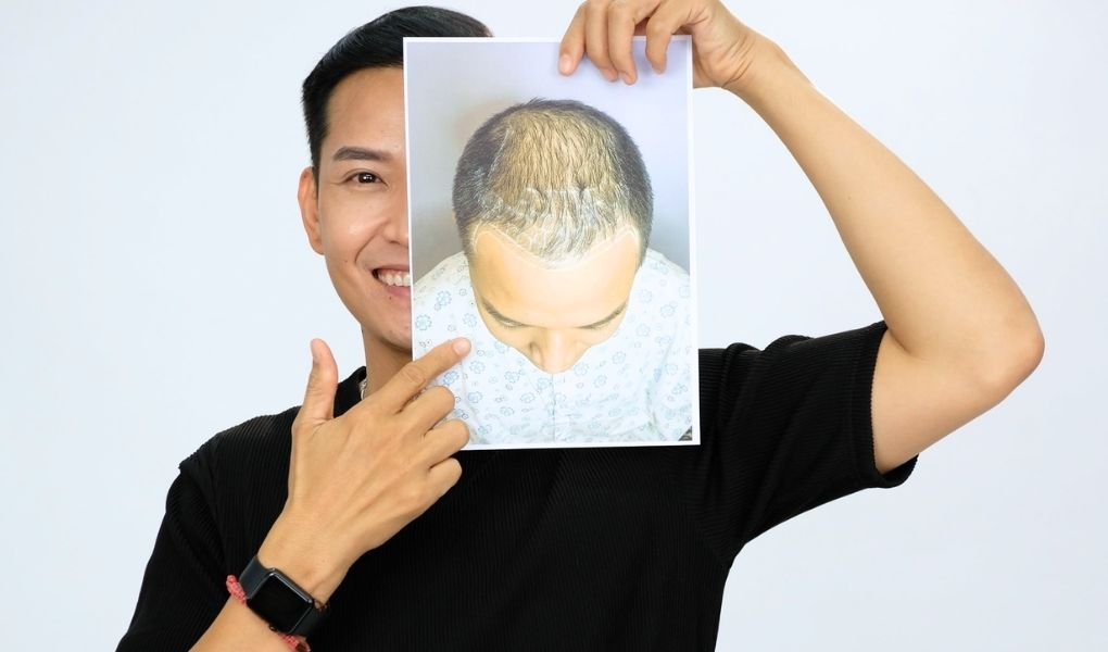 khách hàng bảo nam cấy tóc