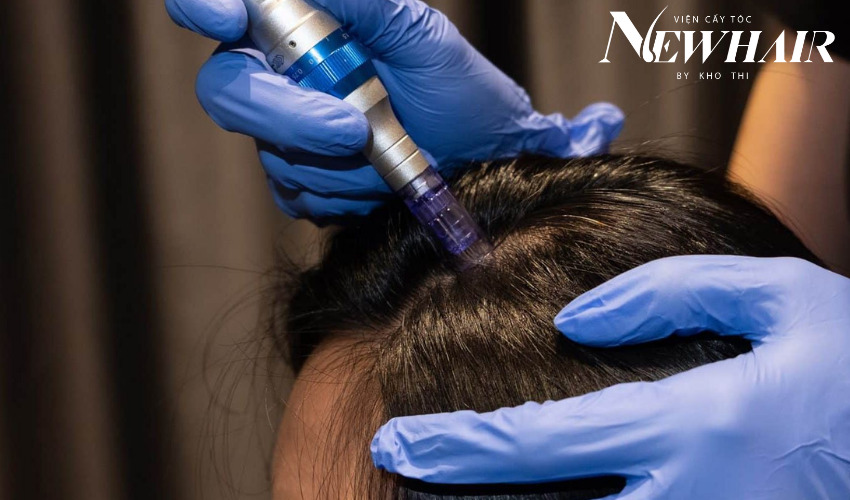 lăn kim trị rụng tóc