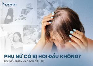 phụ nữ có bị hói đầu không
