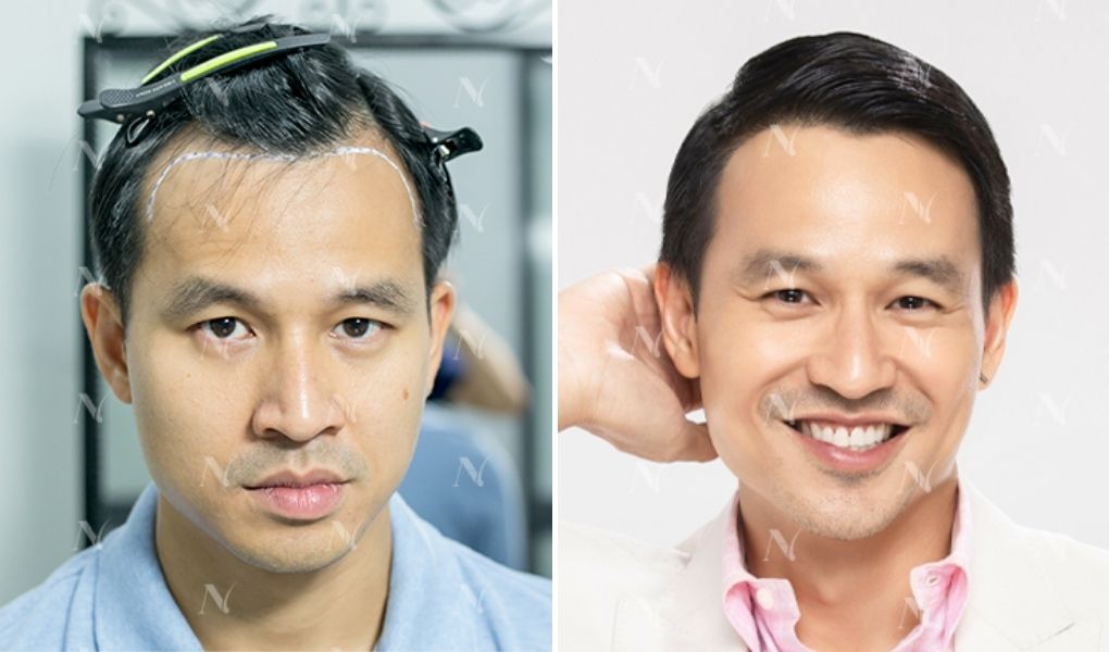 sơn đoàn cấy tóc